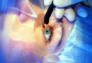 Eye Surgery being performed